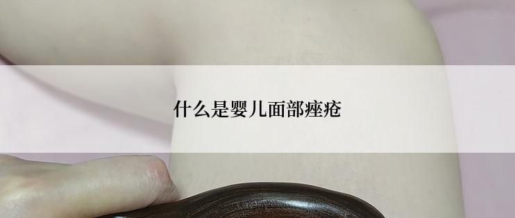什么是婴儿面部痤疮